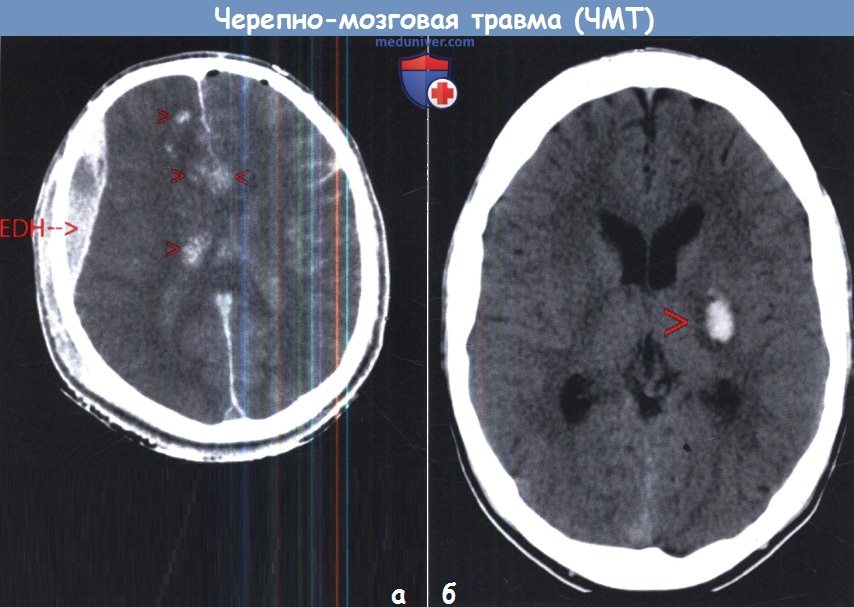 Компьютерная томография при ушибе головного мозга thumbnail