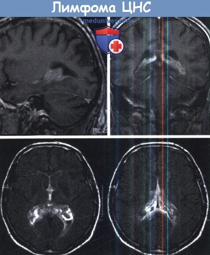 Отек головного мозга при лимфоме thumbnail