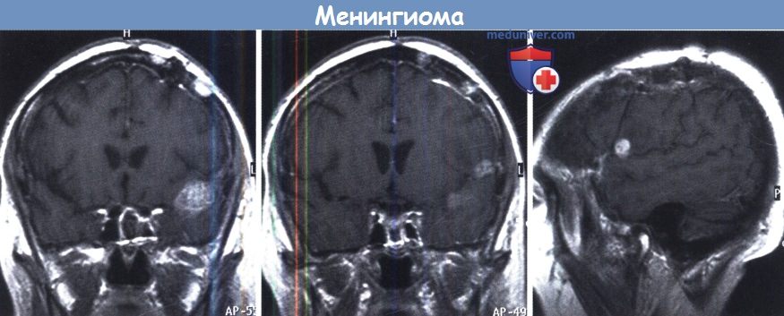 meningioma 4