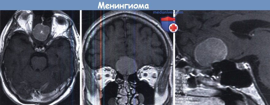 meningioma 7