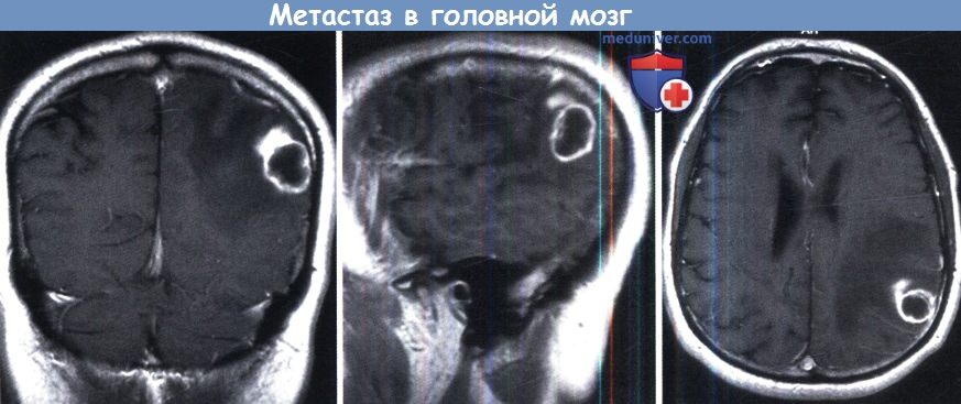 Меланома метастазы в мозг. Метастазы в головном мозге гиподенсные. Единичный метастаз в головном мозге. Метастазы меланомы в головной мозг. Метастазы в головном мозге симптомы.