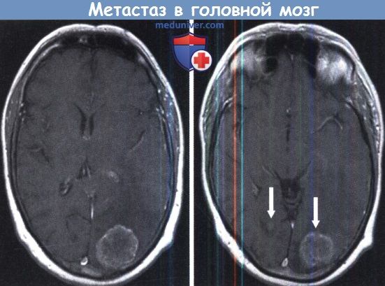 Меланома метастазы в мозг
