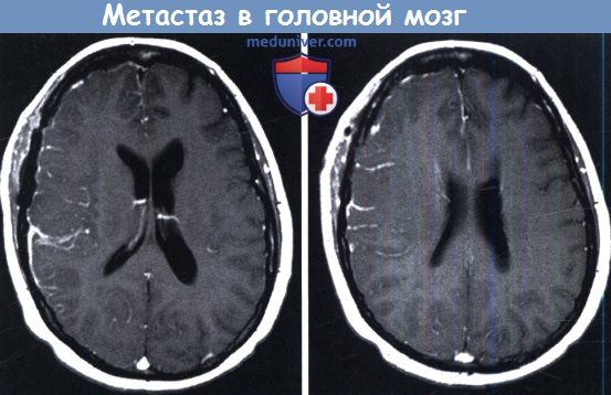 Единичный метастаз в головном мозге. Карциноматоз головного мозга. Удаление метастаза в голове последствия.