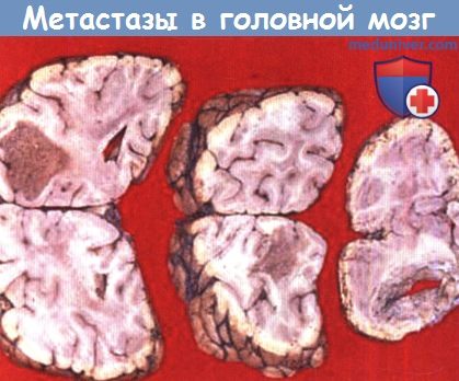 Меланома метастазы в мозг. Метастазы в головном мозге. Известковые метастазы в головном мозге. Метастазы в головной мозг МУБ.