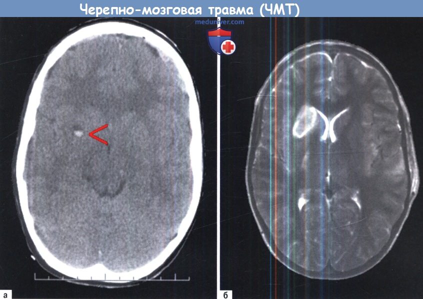 КТ и МРТ при черепно-мозговой травме (ЧМТ)