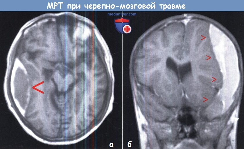МРТ при черепно-мозговой травме (ЧМТ)