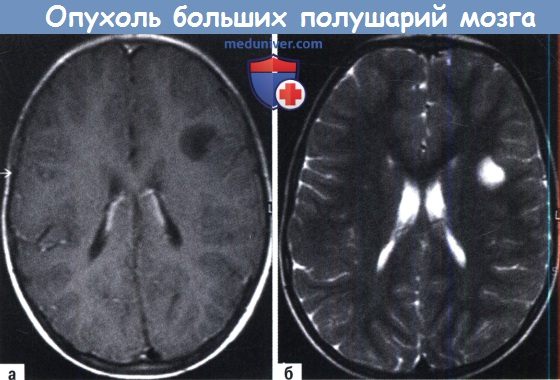 Протокол лечения отека мозга у детей thumbnail