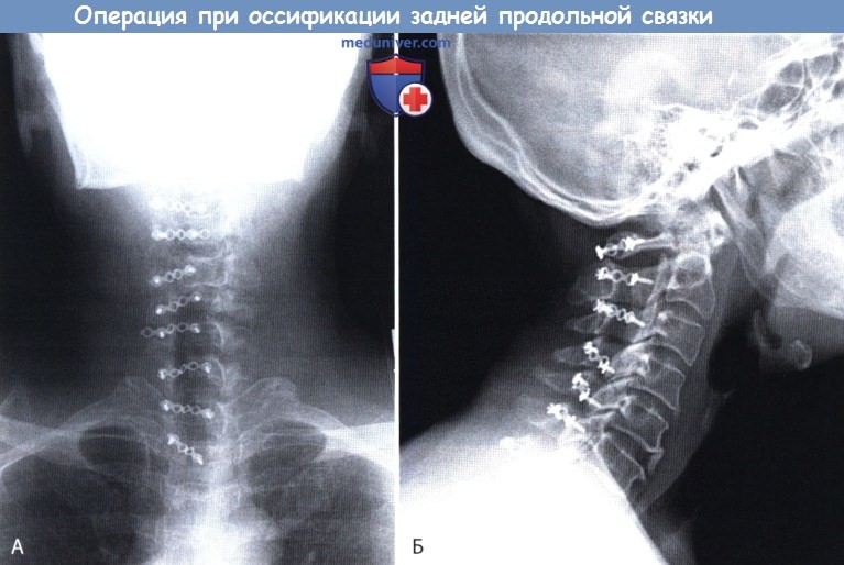 Рентгенограмма после операции по поводу оссификации задней продольной связки позвоночника (ОЗПС, OPLL)