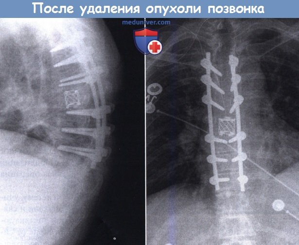 Рентгенограммы после удаления опухоли позвонка
