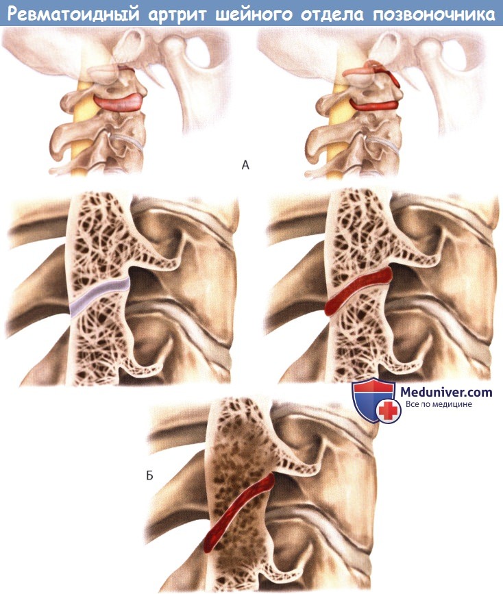 Ревматоидный артрит шейного отдела позвоночника