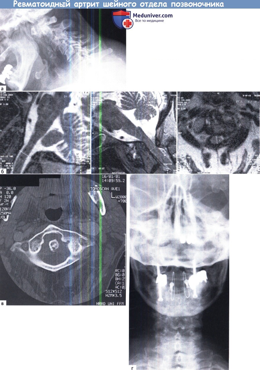 Поражение шейного отдела при ревматоидном артрите thumbnail