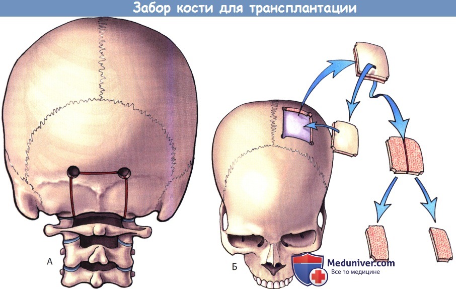 Пересадка кости. Трансплантата теменной кости. Забор трансплантата теменной кости.