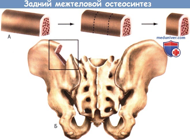 Костный мозг подвздошной кости. Трансплантат из гребня подвздошной кости. Аутотрансплантат из подвздошной кости. Взятие трансплантата из подвздошной кости. Забор трансплантата из крыла подвздошной кости.