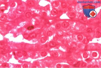 Примеры злокачественной эпителиомы (аденокарциномы) пигментного эпителия сетчатки