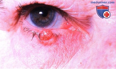 Аденокарцинома потовой железы века глаза