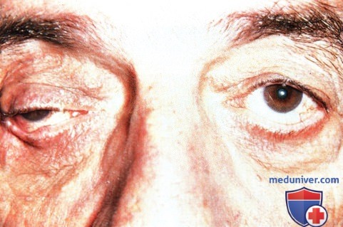 Аденокарцинома потовой железы века глаза