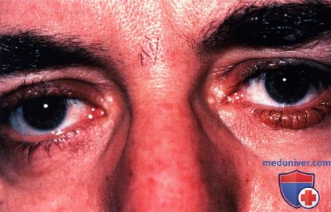 Амилоидоз века глаза