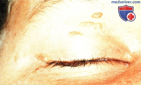 Ангиофиброма века глаза