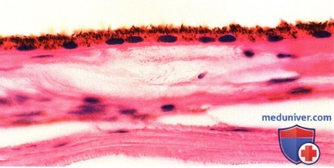 Примеры флюоресцентной ангиографии, гистологии солитарной врожденной гипертрофии пигментного эпителия сетчатки