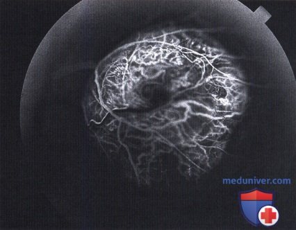 Флюоресцентная ангиография грибовидной меланомы хориоидеи