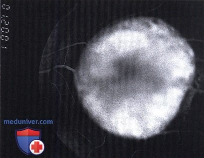 Флюоресцентная ангиография грибовидной меланомы хориоидеи