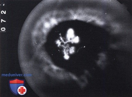 Флюоресцентная ангиография меланомы хориоидеи c неоваскулярной хориоидальной мембраной