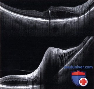 Примеры флюоресцентной ангиографии и оптической когерентной томографии при гемангиобластоме сетчатки