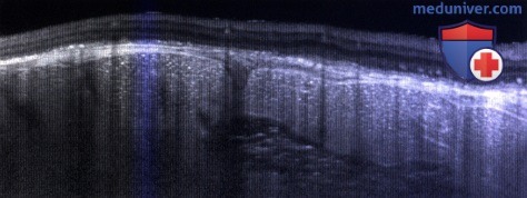 Примеры флюоресцентной ангиографии и ОКТ при остеоме хориоидеи