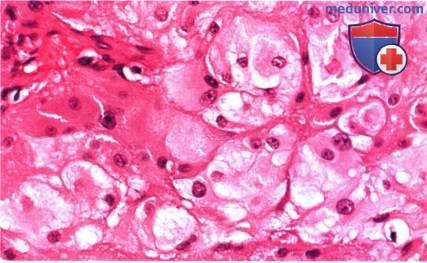 Примеры астроцитарной гамартомы сетчатки при туберозном склерозе