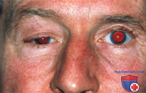 Атипичная лимфома глазницы