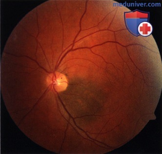Примеры аутофлюоресценции глазного дна при меланоме хориоидеи