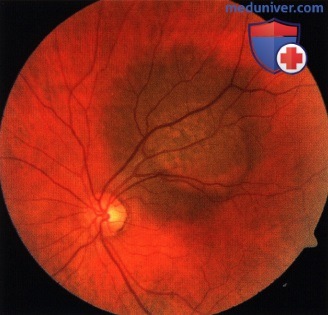 Примеры аутофлюоресценции глазного дна при меланоме хориоидеи