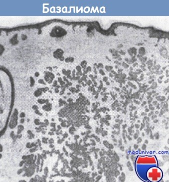 Базалиома (базальноклеточная карцинома кожи)