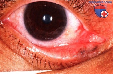 Базальноклеточная карцинома века глаза