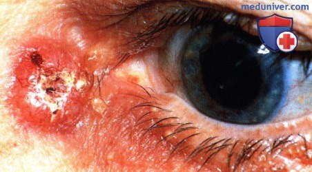 Базальноклеточная карцинома века глаза