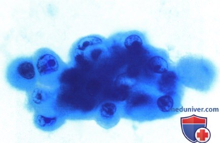 Примеры биопсии эпителиомы (аденомы) пигментного эпителия сетчатки
