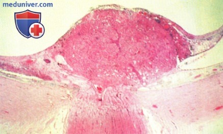 Примеры биопсии эпителиомы (аденомы) пигментного эпителия сетчатки