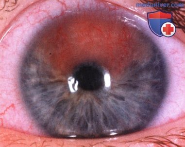 Примеры тонкоигольной аспирационной биопсии новообразований переднего отрезка глаза