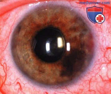 Примеры тонкоигольной аспирационной биопсии новообразований переднего отрезка глаза