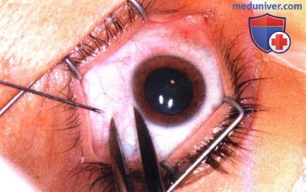 Примеры тонкоигольной аспирационной биопсии новообразований заднего отрезка глаза