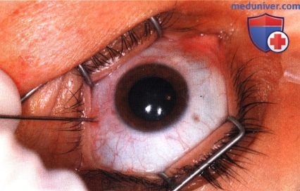 Примеры тонкоигольной аспирационной биопсии новообразований заднего отрезка глаза