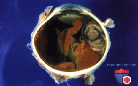 Пример тонкоигольной аспирационной биопсии (ТАБ) при меланоме хориоидеи и цилиарного тела