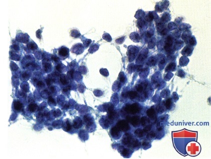 Пример тонкоигольной аспирационной биопсии (ТАБ) при меланоме хориоидеи и цилиарного тела