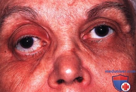 Болезнь Кимуры глазницы (ангиолимфоидная гиперплазия с эозинофилией)