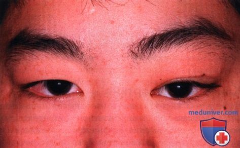 Болезнь Кимуры глазницы (ангиолимфоидная гиперплазия с эозинофилией)