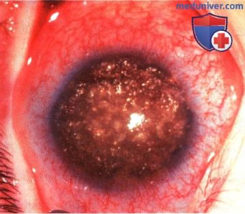 Примеры болезни Коатса симулирующей ретинобластому