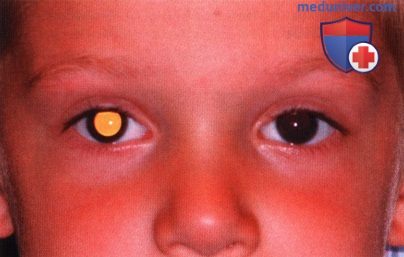 Примеры болезни Коатса симулирующей ретинобластому