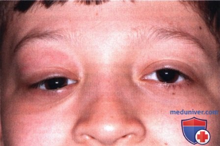 Болезнь Розаи-Дорфмана глазницы (синусный гистиоцитоз с массивной лимфаденопатией)