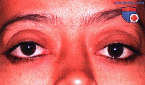 Болезнь Розаи-Дорфмана глазницы (синусный гистиоцитоз с массивной лимфаденопатией)