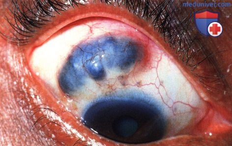 Неопухолевые болезни симулирующие меланому заднего отдела сосудистой оболочки глаза